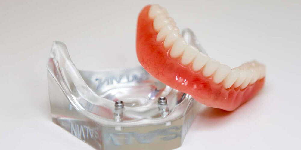 Removable Implant Support Dentures Montreal Lupien Denturists
